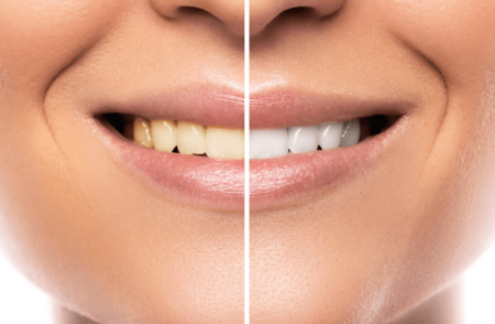Evinizde doğal yollarla dişlerinizi beyazlatın!