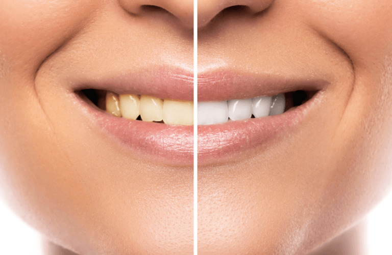 Evinizde doğal yollarla dişlerinizi beyazlatın!