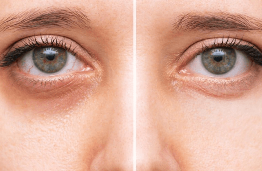 Göz altı morlukları neden olur? Göz altı morlukları nasıl geçer?
