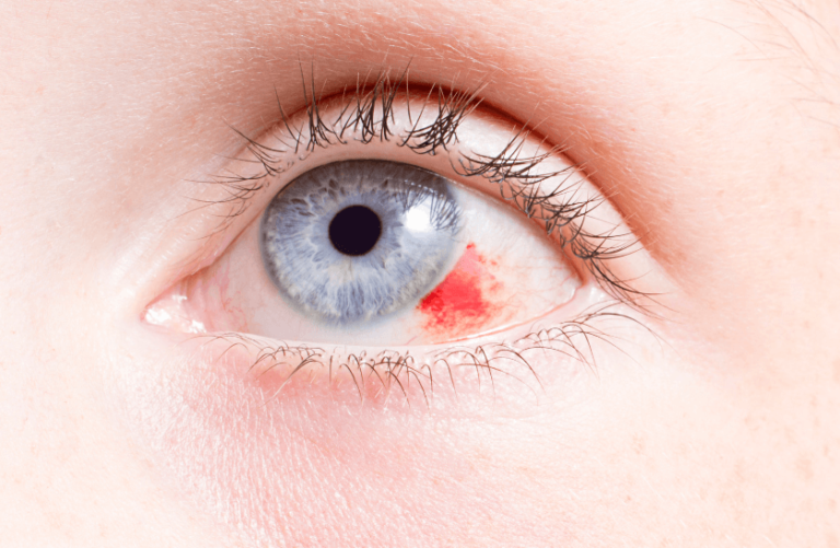 Yaz aylarında sık rastlanan göz enfeksiyonları nelerdir?